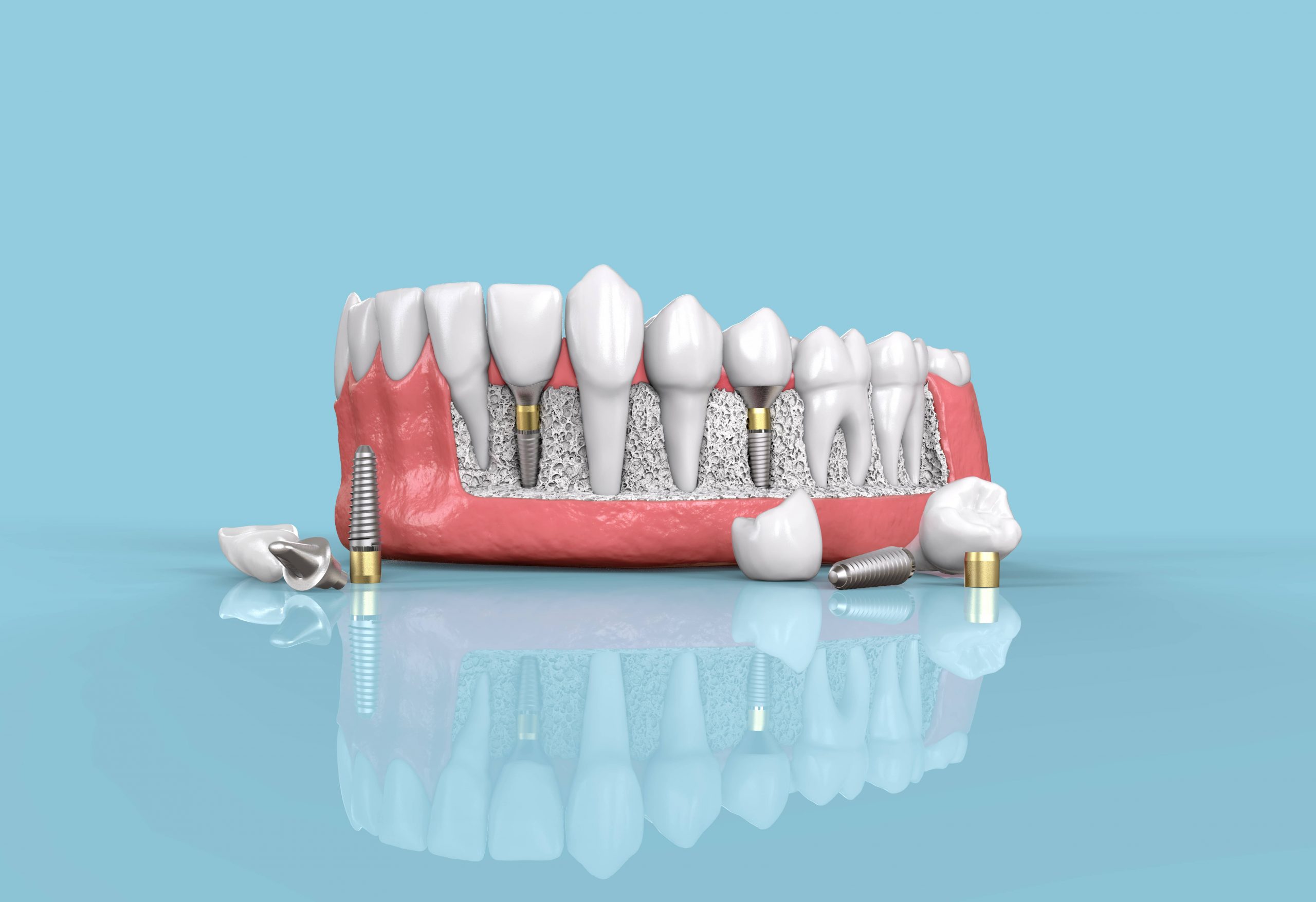 implantologia clinica dental la bisbal