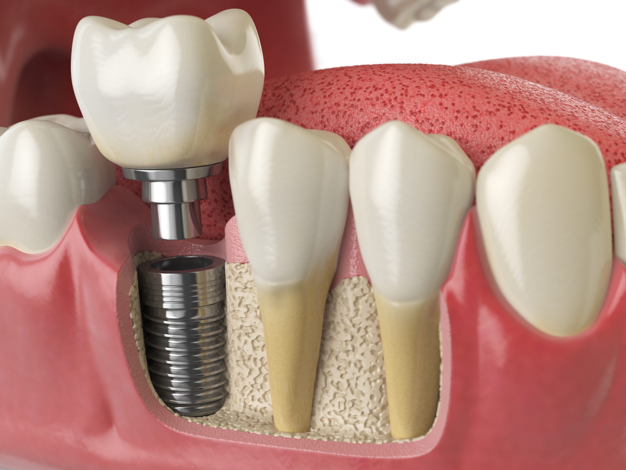 implantologia clinica dental gironella